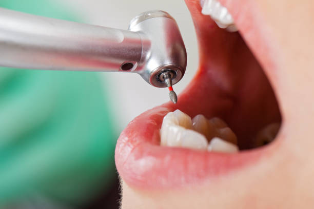Best Emergency Tooth Extraction in St George, SC